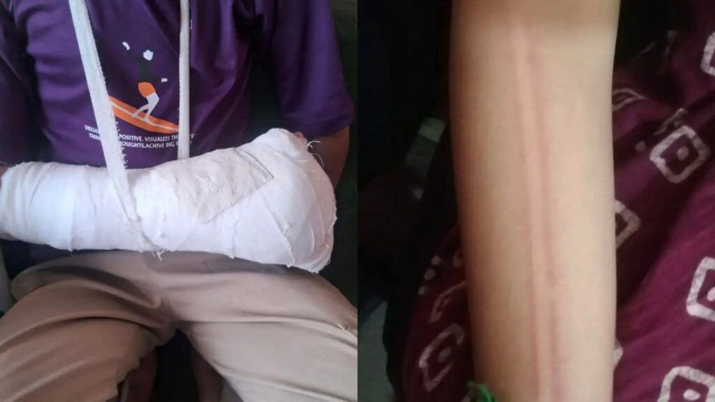 बानसूर में शिक्षक की क्रूरता: कक्षा-7 के छात्र की बेरहमी से पिटाई, हाथ फ्रैक्चर—मामला दर्ज